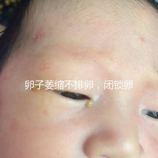 卵子萎縮不排卵,閉鎖卵泡形成原因與這4點(diǎn)有關(guān)