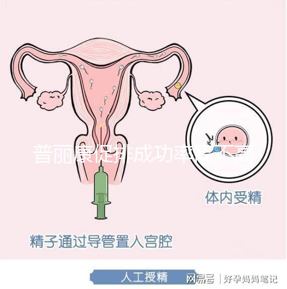 普麗康促排成功率高不高揭秘，能否取出卵泡的關鍵看…