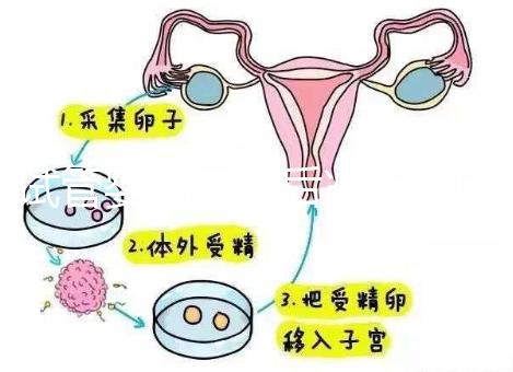 試管嬰兒二超后減藥原因已找到，對胎兒沒影響別瞎擔心